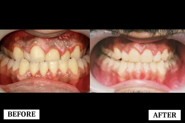 Smile Transformation 3