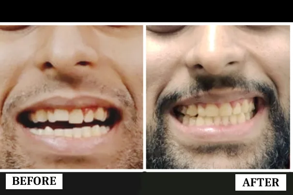 Smile Transformation 4