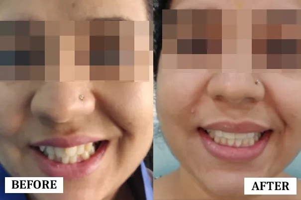 Smile Transformation 6