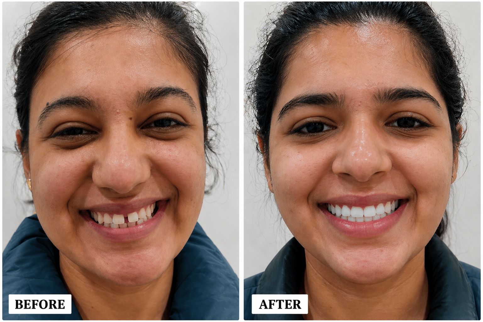 Smile Transformation 6